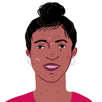 Illustration d'une adolescente avec des boutons, un appareil dentaire et portant un haut rouge