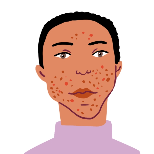 Illustration d'une adolescente avec des boutons sur le visage et portant un col roulé violet