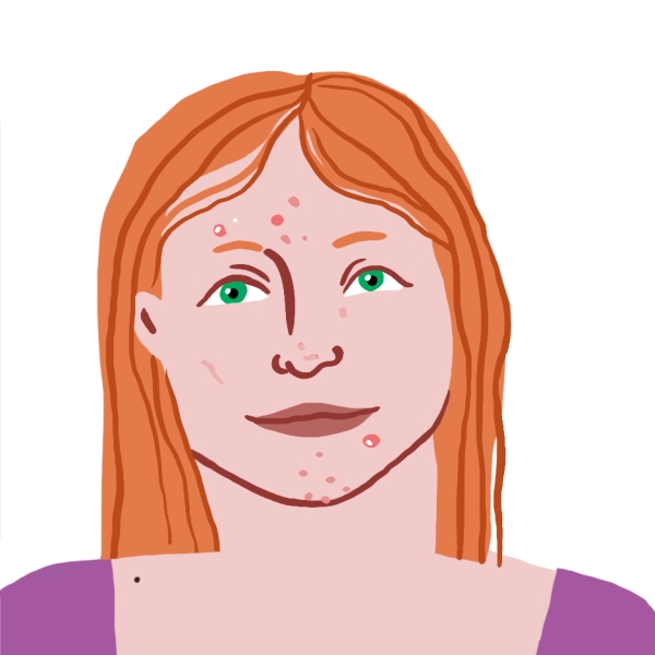 Illustration d'une adolescente avec des boutons sur le visage et portant un haut violet