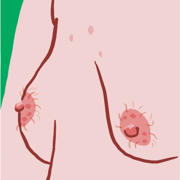 Illustration de poils sur les seins