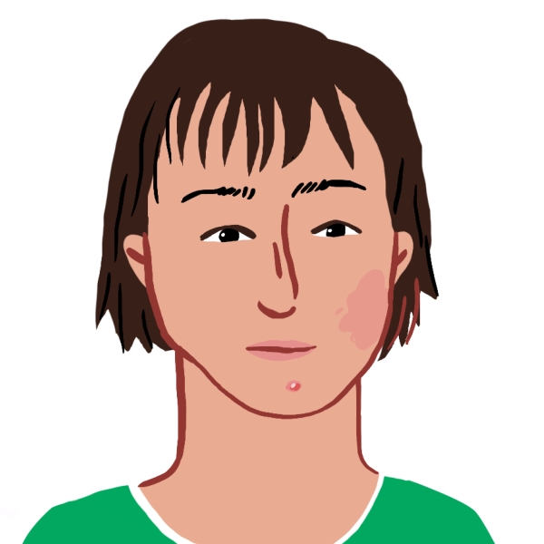 Illustration de visage d'ado avec un angiome et un bouton sur le menton et portant un T-shirt vert à col blanc