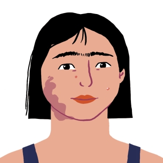 Illustration d'une adolescentes avec une tâche lie de vin sur le visage et portant un débardeur bleu
