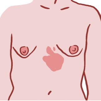 Illustration d'une poitrine avec un angiome